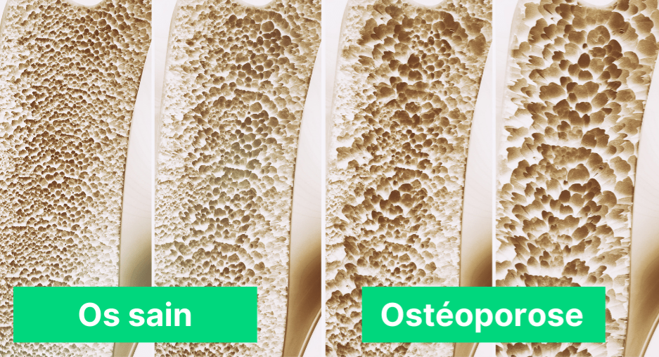 Ostéoporose Comparaison os sain et osteoporose- Florence Drean Naturopathe